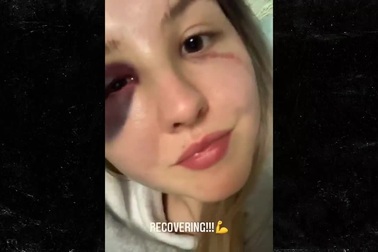 Gương mặt của Cheyenne Hanson sau khi trận đấu kết thúc vài ngày