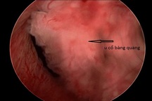 Các phương pháp điều trị ung thư bàng quang