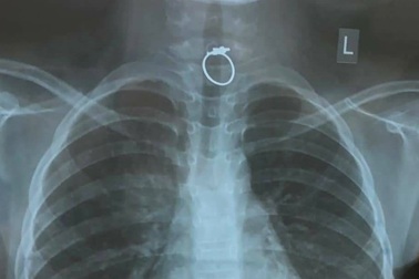 Nuốt chiếc nhẫn được tặng trong ngày Valentine bé gái phải cấp cứu