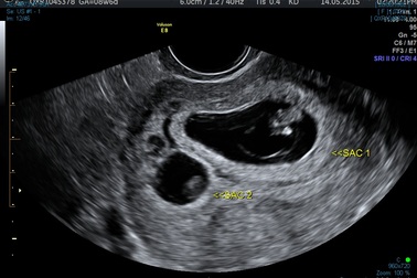 Hy hữu ca thụ thai khi đang mang thai