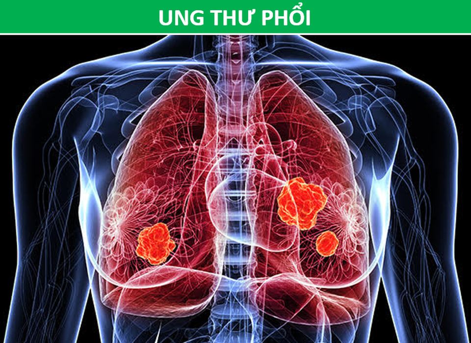 Đau vùng lưng dưới có thể là tín hiệu cảnh báo loại ung thư nào? - 3 Đau vùng lưng dưới có thể là tín hiệu cảnh báo loại ung thư nào? - 3