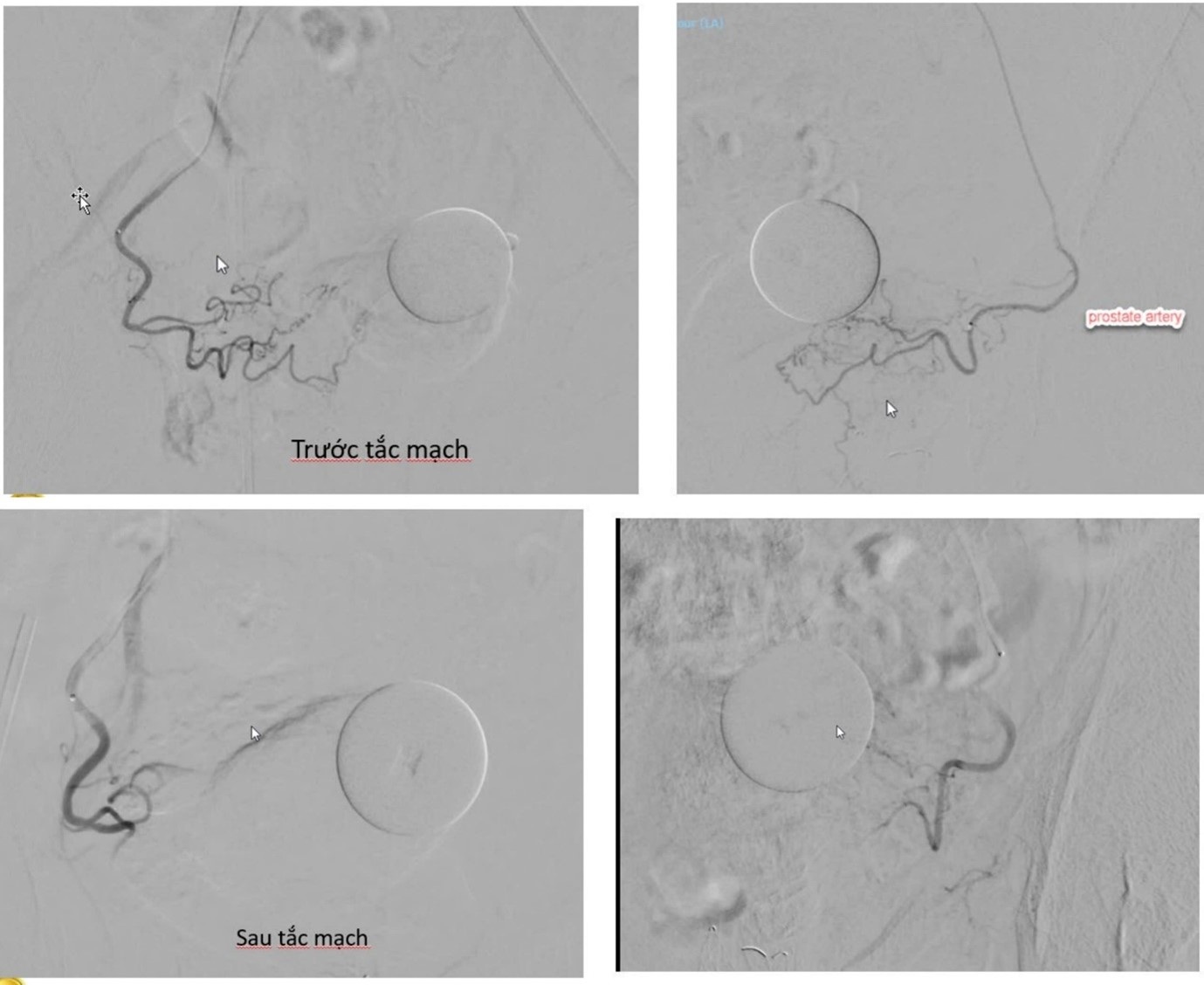Thuyên tắc mạch điều trị u tiền liệt tuyến: Không cần phẫu thuật, hồi phục nhanh - 3