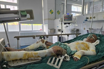 Ngã vào chảo mỡ bò đang sôi, người bố 2 con bỏng 75% cơ thể