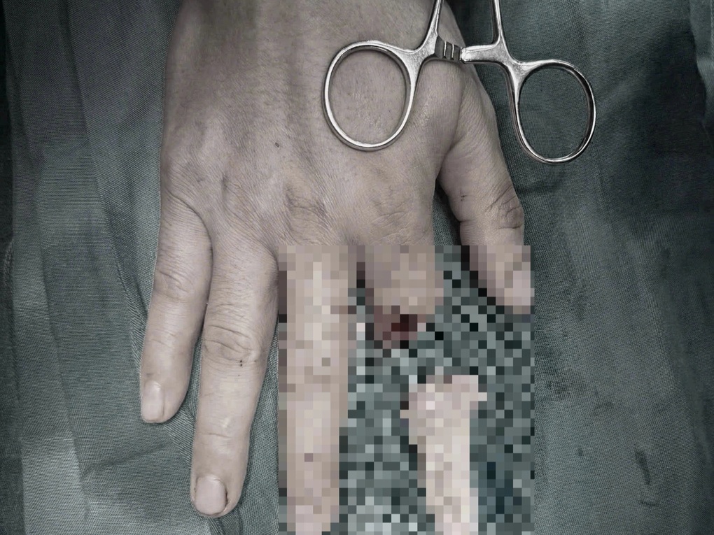 Pela primeira vez no Vietnã, um dedo decepado após 25 horas foi reimplantado com sucesso - 1 Lần đầu tiên tại Việt Nam, ngón tay đứt rời 25 giờ được nối thành công - 1