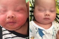 Nhiễm tụ cầu, bé 4 tháng tuổi bong loét da mặt do mẹ đắp thuốc lá