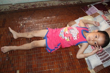 Bé 3 tuổi nguy kịch vì mắc chứng xuất huyết giảm tiểu cầu hiếm gặp