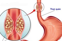 Ung thư thực quản có thể chữa khỏi nếu phát hiện sớm
