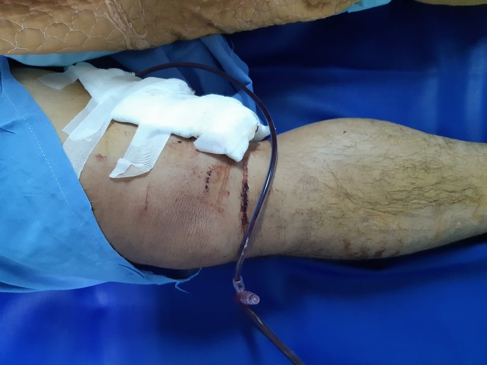 Cứu sống thanh niên bị đạn bắn chim bắn thủng động, tĩnh mạch đùi - 2 Cứu sống thanh niên bị đạn bắn chim bắn thủng động, tĩnh mạch đùi - 2