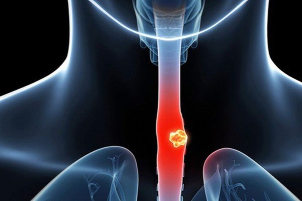 7 yếu tố làm tăng nguy cơ ung thư thực quản - 1 7 yếu tố làm tăng nguy cơ ung thư thực quản - 1