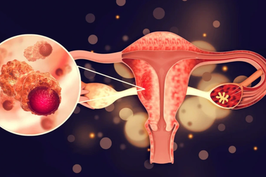 Tuổi nào có nguy cơ mắc ung thư buồng trứng?