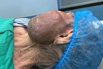 Cắt bỏ khối u khổng lồ trên mặt bệnh nhân 99 tuổi