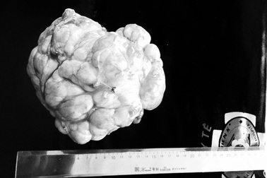 Bé trai 4 tuổi mang khối u 3kg chiếm toàn bộ ổ bụng