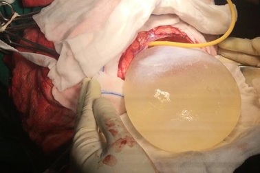 Nang sán dây "lớn nhất lịch sử y học" trong đầu cô bé 12 tuổi