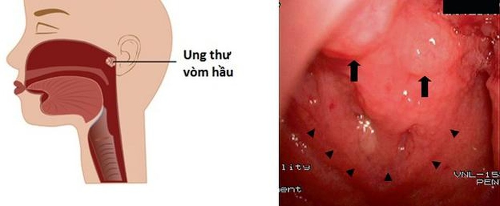 Ung thư vòm họng - dấu hiệu nào để phát hiện sớm? - 1 Ung thư vòm họng - dấu hiệu nào để phát hiện sớm? - 1