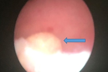 Cậu bé 10 tháng tuổi tắc tiểu vì sỏi thận