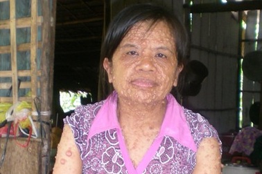 Người phụ nữ 40 năm sống cùng hàng trăm cái bướu