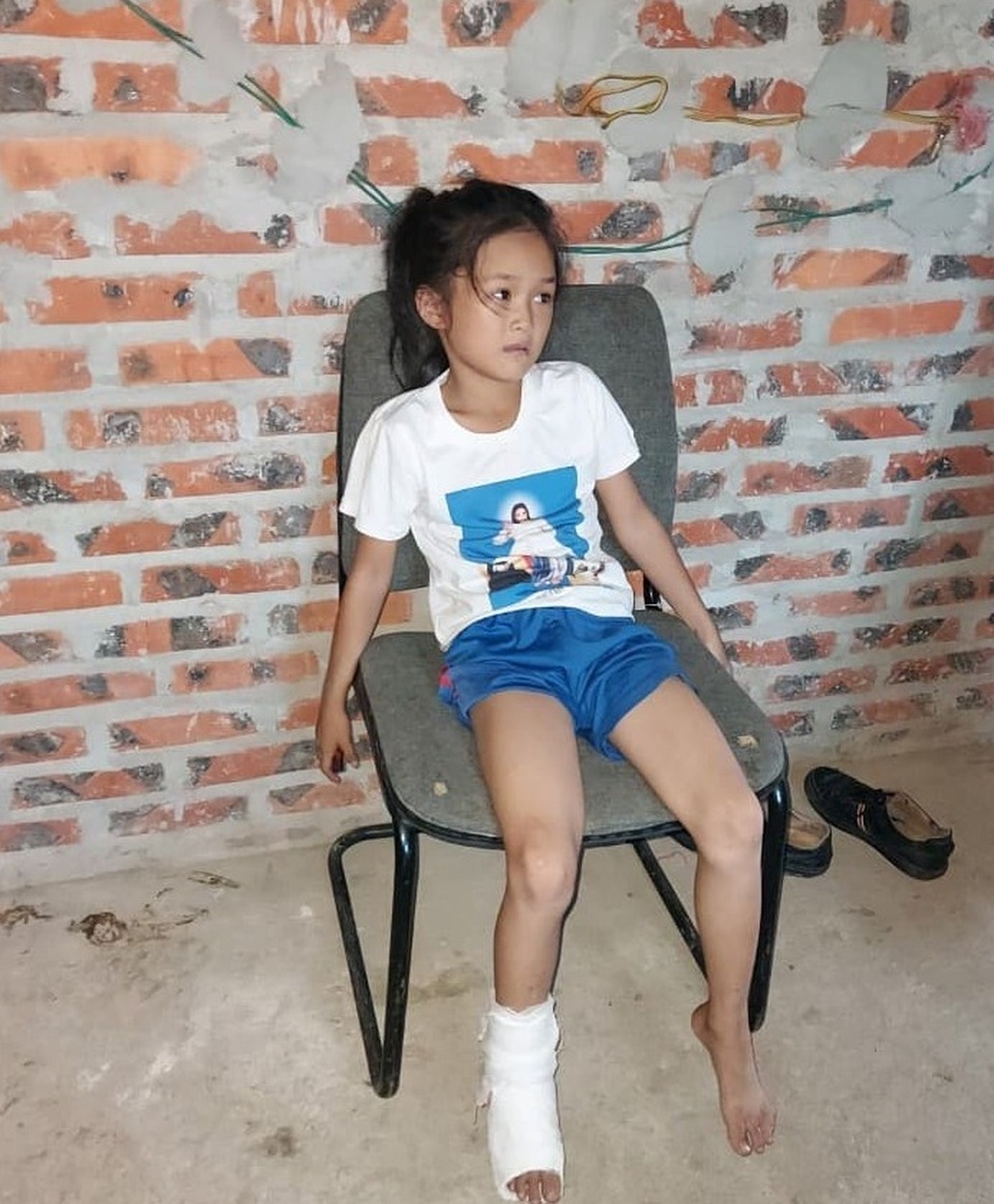 truong9.jpeg bị mẻ, rạn xương, một phần thanh sắt đâm vào chân làm lộ xương bên trong phải khâu nhiều mũi.