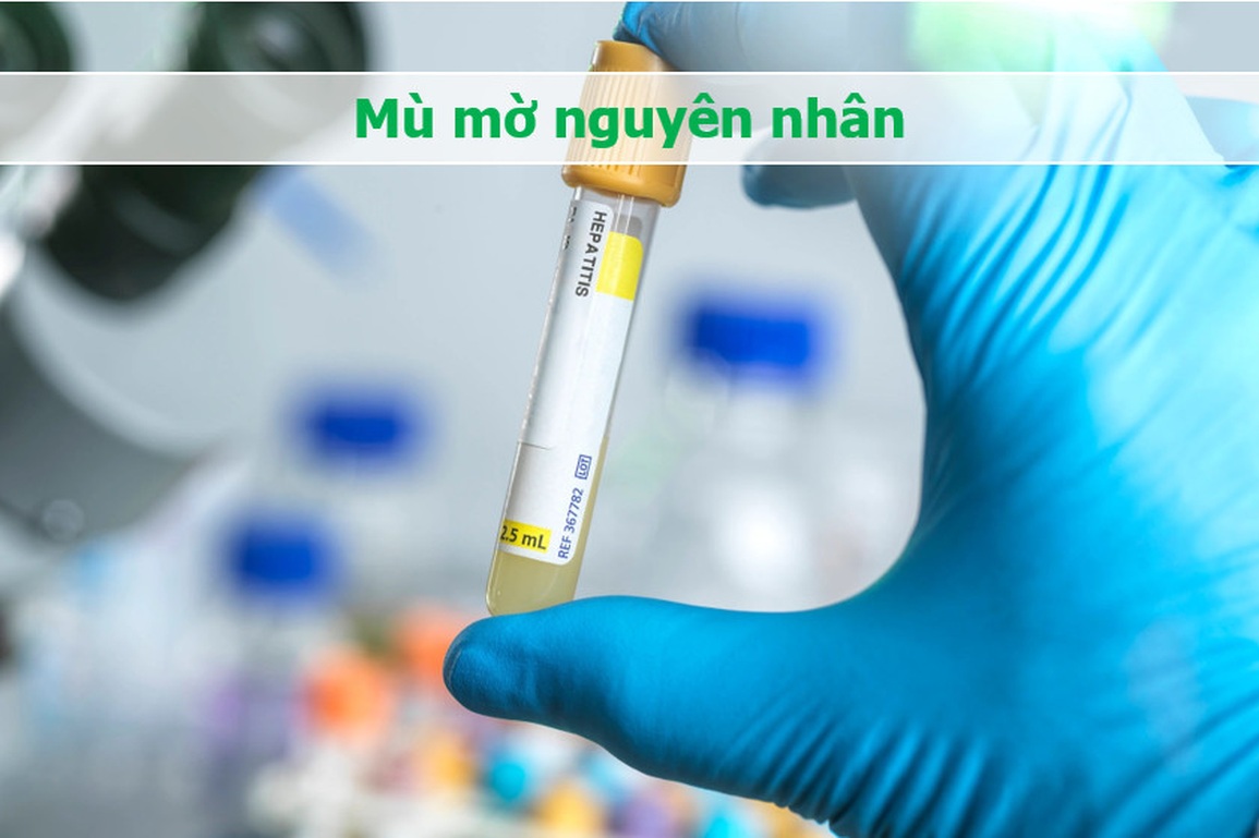 Thông tin bất ngờ về nguồn gốc của dịch viêm gan bí ẩn - 2 Thông tin bất ngờ về nguồn gốc của dịch viêm gan bí ẩn - 2