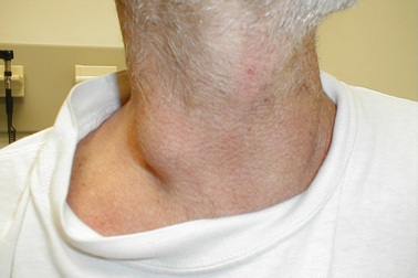 Những dấu hiệu bất thường ở cổ cảnh báo ung thư cận kề