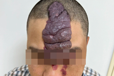 Giải cứu gương mặt có "chú sâu" khổng lồ bám chặt suốt 36 năm