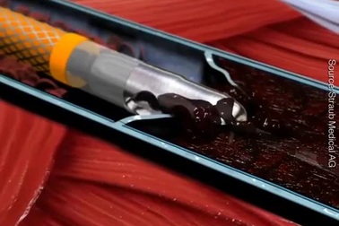 Máy phá máu đông: Cứu tinh của hàng triệu người trên thế giới!