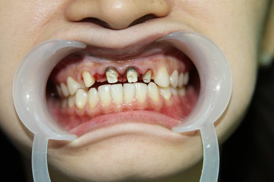 Nha khoa Anna - địa chỉ bọc răng sứ tin cậy của nhiều khách hàng - 2 Nha khoa Anna - địa chỉ bọc răng sứ tin cậy của nhiều khách hàng - 2