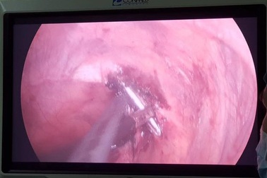 Kỳ lạ chiếc đinh "chui" xuyên qua phổi, tuỷ sống bệnh nhân