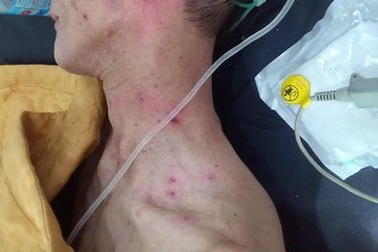 Hai cha con nhập viện nguy kịch vì bị ong đốt hàng trăm nốt