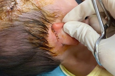 Bé gái 19 tháng tuổi bị chó nhà hàng xóm cắn liên tục vào vùng đầu mặt