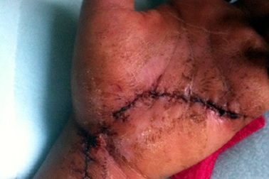 Đi ăn tối, một thanh niên bị chém gần đứt lìa bàn tay