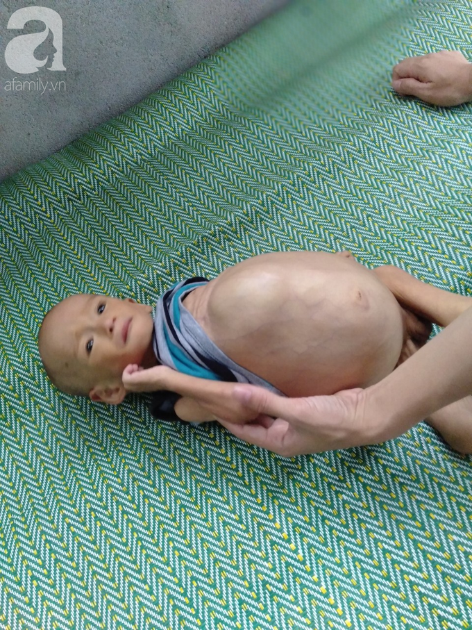 Sự sống mong manh của bé trai 1 tuổi, chỉ nặng 6kg, bụng phình to như cái trống mà mẹ nghèo không tiền chữa trị - Ảnh 9. Sự sống mong manh của bé trai 1 tuổi, chỉ nặng 6kg, bụng phình to như cái trống mà mẹ nghèo không tiền chữa trị - Ảnh 9.