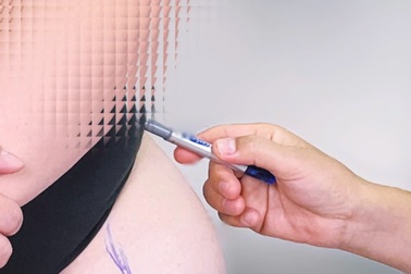 Nữ Việt kiều mắc hội chứng cực hiếm, tưởng nhầm "béo phì" suốt 20 năm