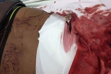 Phẫu thuật cứu nam thanh niên bị đâm thấu lưng vì "dám giật bạn gái"