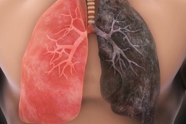 Các triệu chứng sớm cảnh báo ung thư phổi