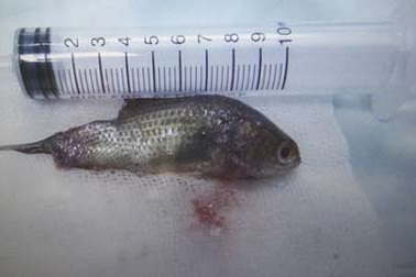 Suýt chết vì cá rô chui vào họng