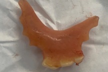 Bác sĩ lấy hàm răng giả từ thực quản bệnh nhân