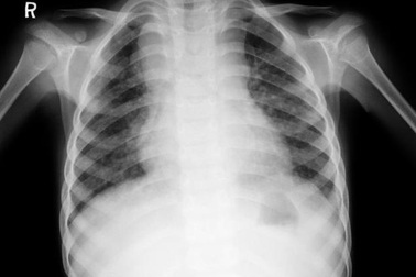 Nhiều trẻ em có nguy cơ tử vong do thiếu thuốc điều trị lao phù hợp