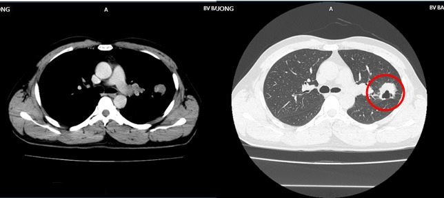 Bất ngờ phát hiện ung thư từ dấu hiệu tưởng bệnh vặt - 1