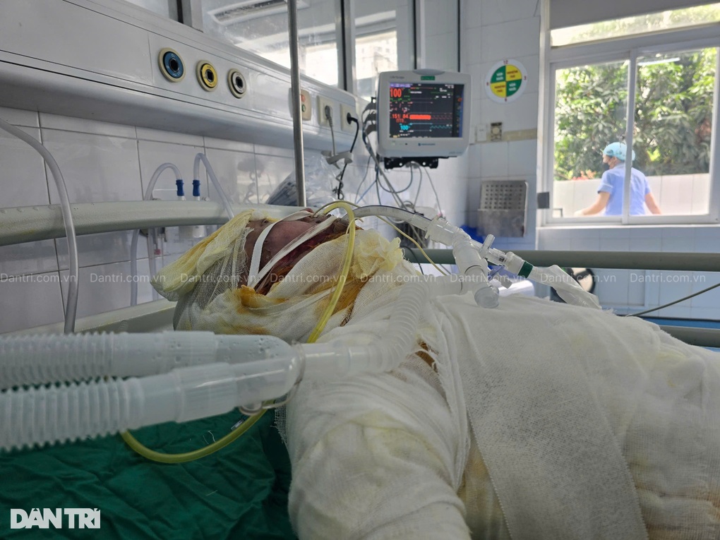 Bác sĩ kêu gọi cứu chàng trai dân tộc Mông nguy kịch vì bỏng điện - 5 Bác sĩ kêu gọi cứu chàng trai dân tộc Mông nguy kịch vì bỏng điện - 5