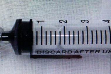 Nhiễm trùng nặng vì “bỏ quên” chân nhang 2cm trong lỗ rò tai