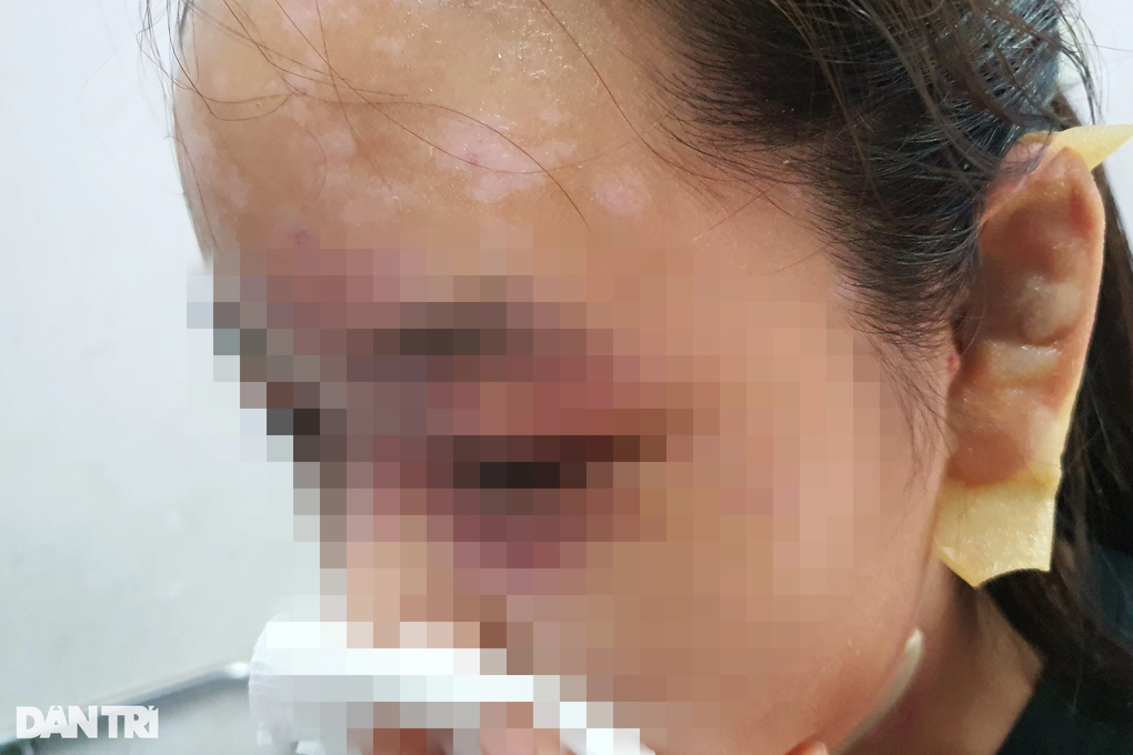 Mua chai hóa chất 75.000 đồng về thông bồn cầu, cha con ở TPHCM bỏng nát da - 3 Mua chai hóa chất 75.000 đồng về thông bồn cầu, cha con ở TPHCM bỏng nát da - 3