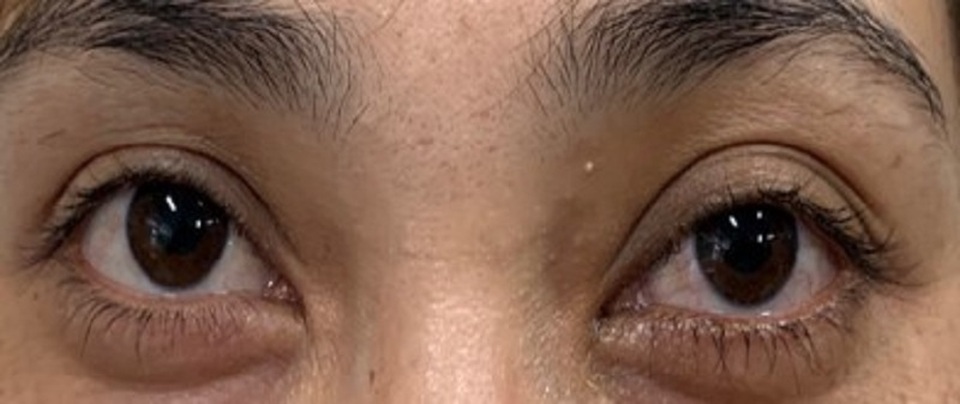 Tưởng đau mắt đỏ, bệnh nhân suýt mù vì bệnh lý hiếm gặp - 4 Tưởng đau mắt đỏ, bệnh nhân suýt mù vì bệnh lý hiếm gặp - 4