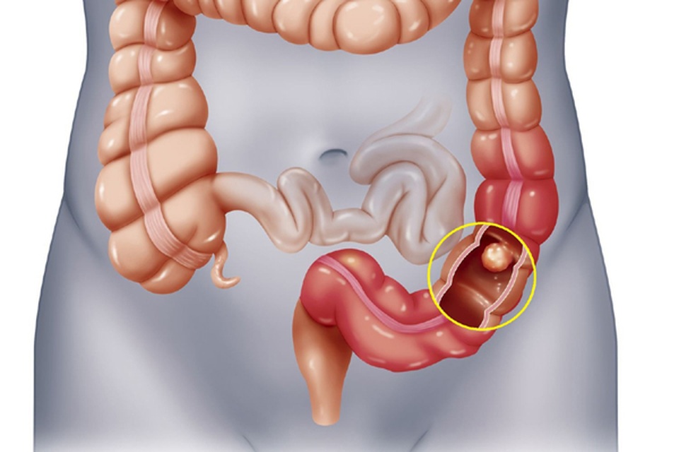 Hiểu về ung thư đại trực tràng - 1 Hiểu về ung thư đại trực tràng - 1