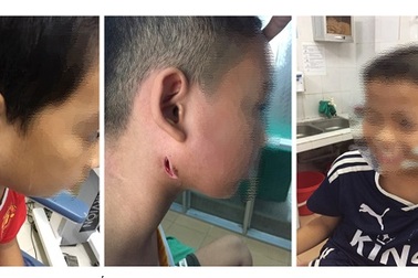 3 trẻ tưởng quai bị hoá nhiễm vi khuẩn chết người