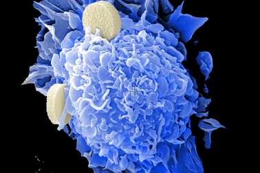 Phát hiện chất béo… tiêu diệt ung thư ngay trong cơ thể người