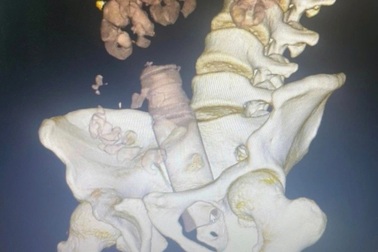 Nam thanh niên nhập viện vì đồ chơi tình dục tự chế