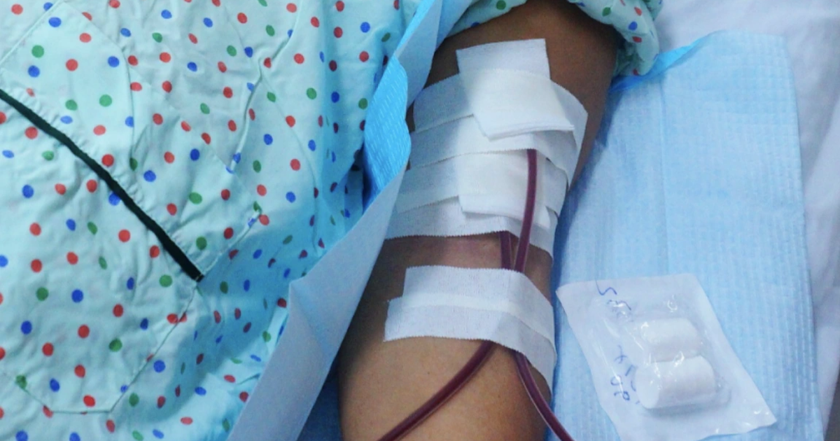 Chuyên gia nói gì về việc "lọc máu ngừa đột quỵ"?