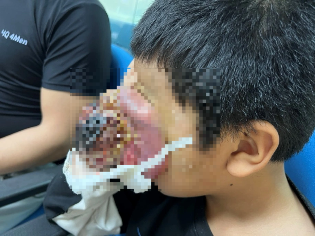 Cậu bé 4 tuổi bị nổ mắt, u to như quả ổi - 1 Cậu bé 4 tuổi bị nổ mắt, u to như quả ổi - 1