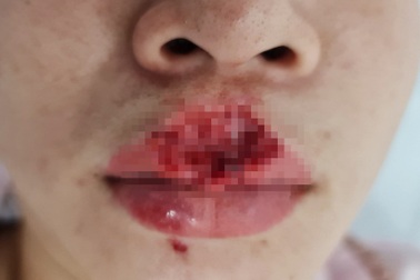 Vuốt ve chó đang ăn, cô gái ở Vũng Tàu bị cắn đứt môi