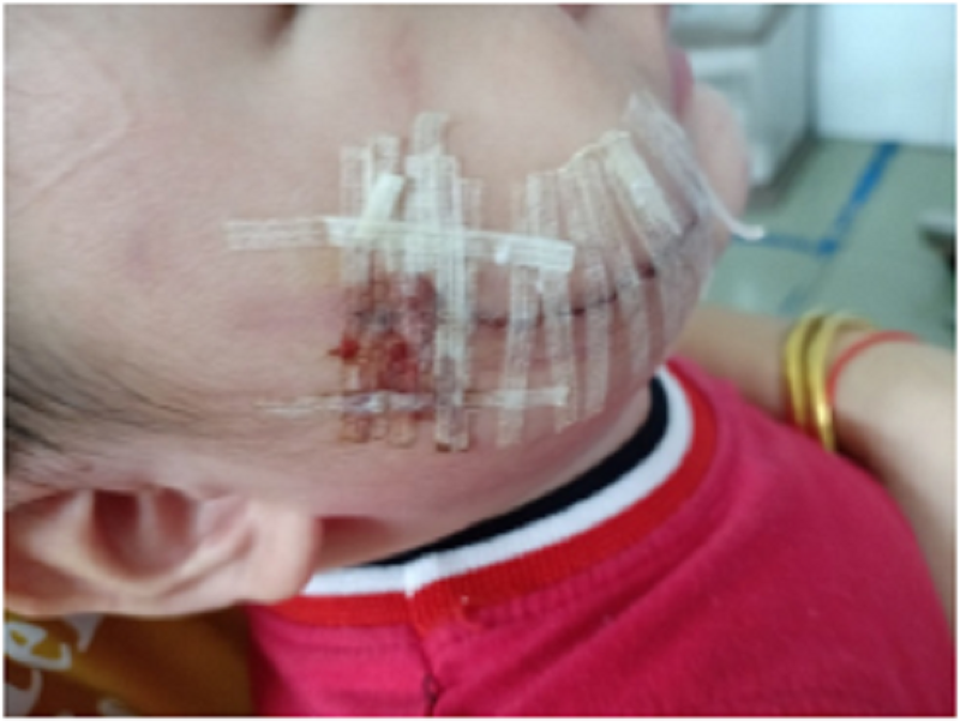 Vấp phải con chó đang ngủ, cháu bé 2 tuổi bị cắn nát mặt - 1 Vấp phải con chó đang ngủ, cháu bé 2 tuổi bị cắn nát mặt - 1